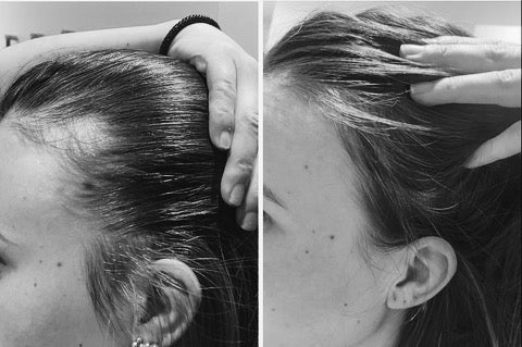 Hårvækst: Sophias historie